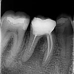 Intraoralna RVG snimka zuba