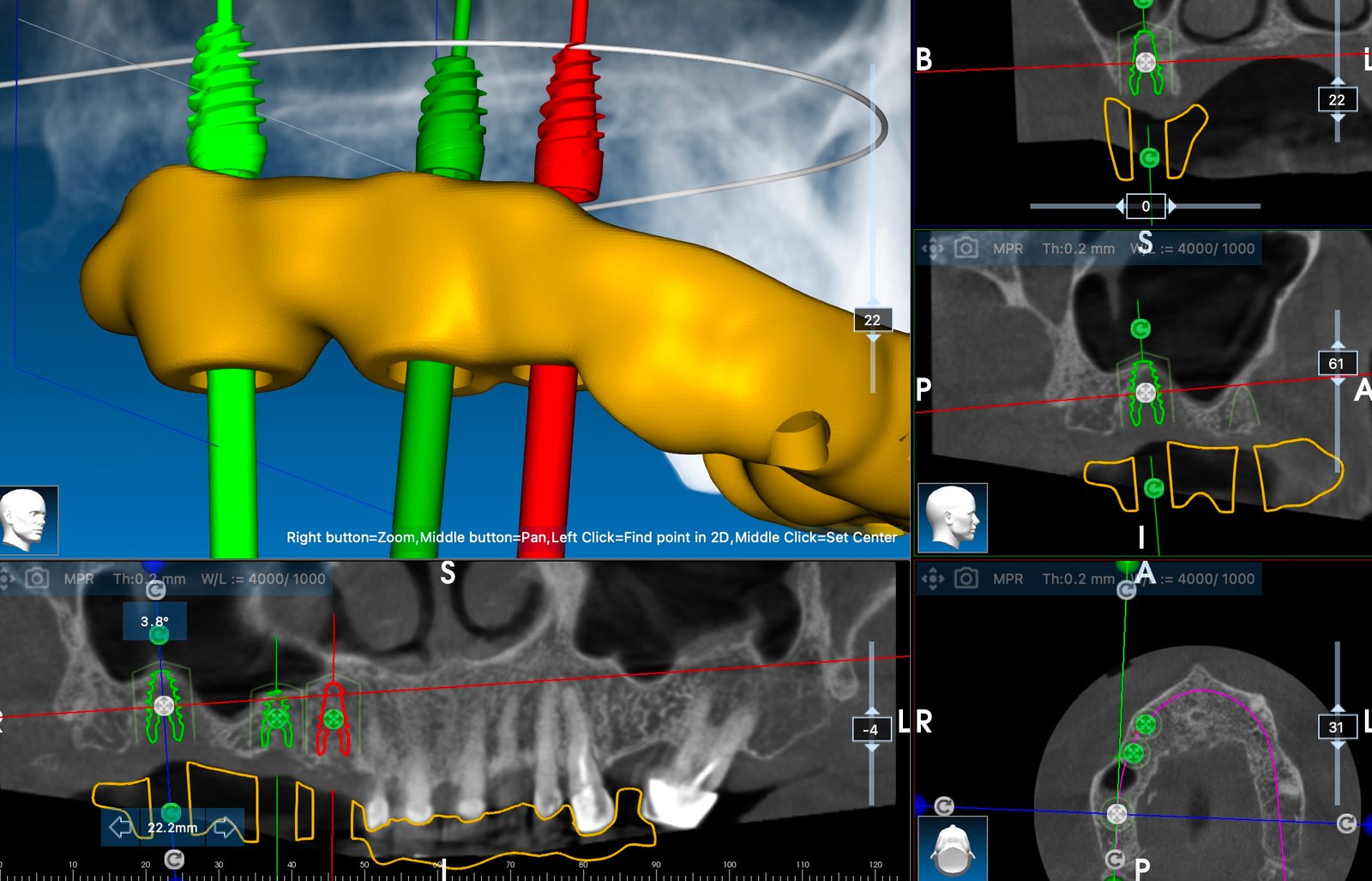 kompjutersko planiranje dentalnih implantata
